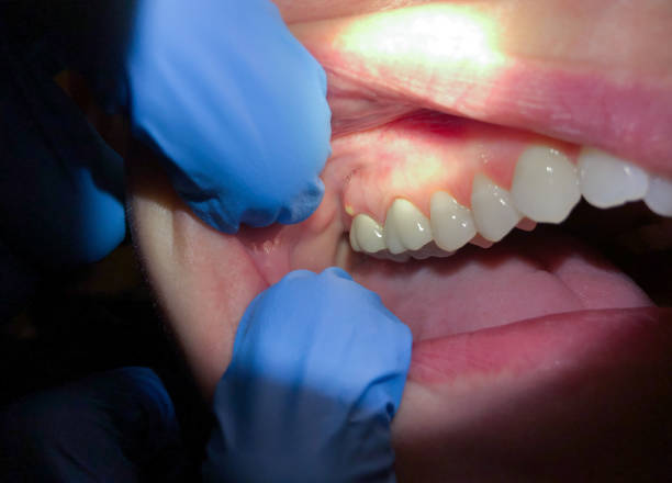 Best Knocked-Out Tooth (Avulsed Tooth) Treatment in Heavener, OK